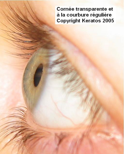 Image of an healthy and transparent cornea.