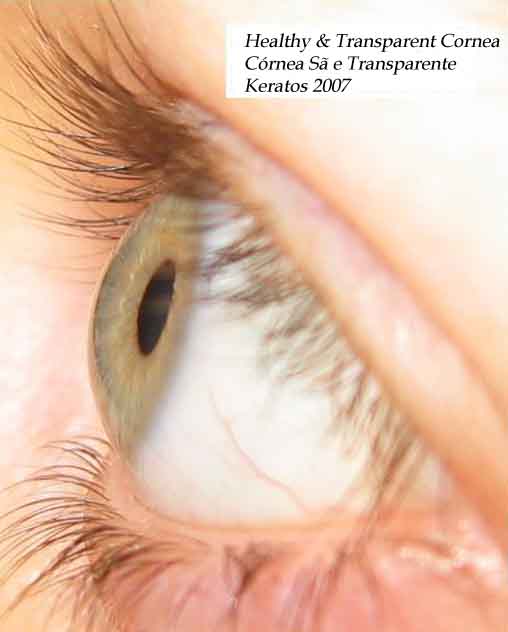 Heatlhy and trasnparent cornea - picture